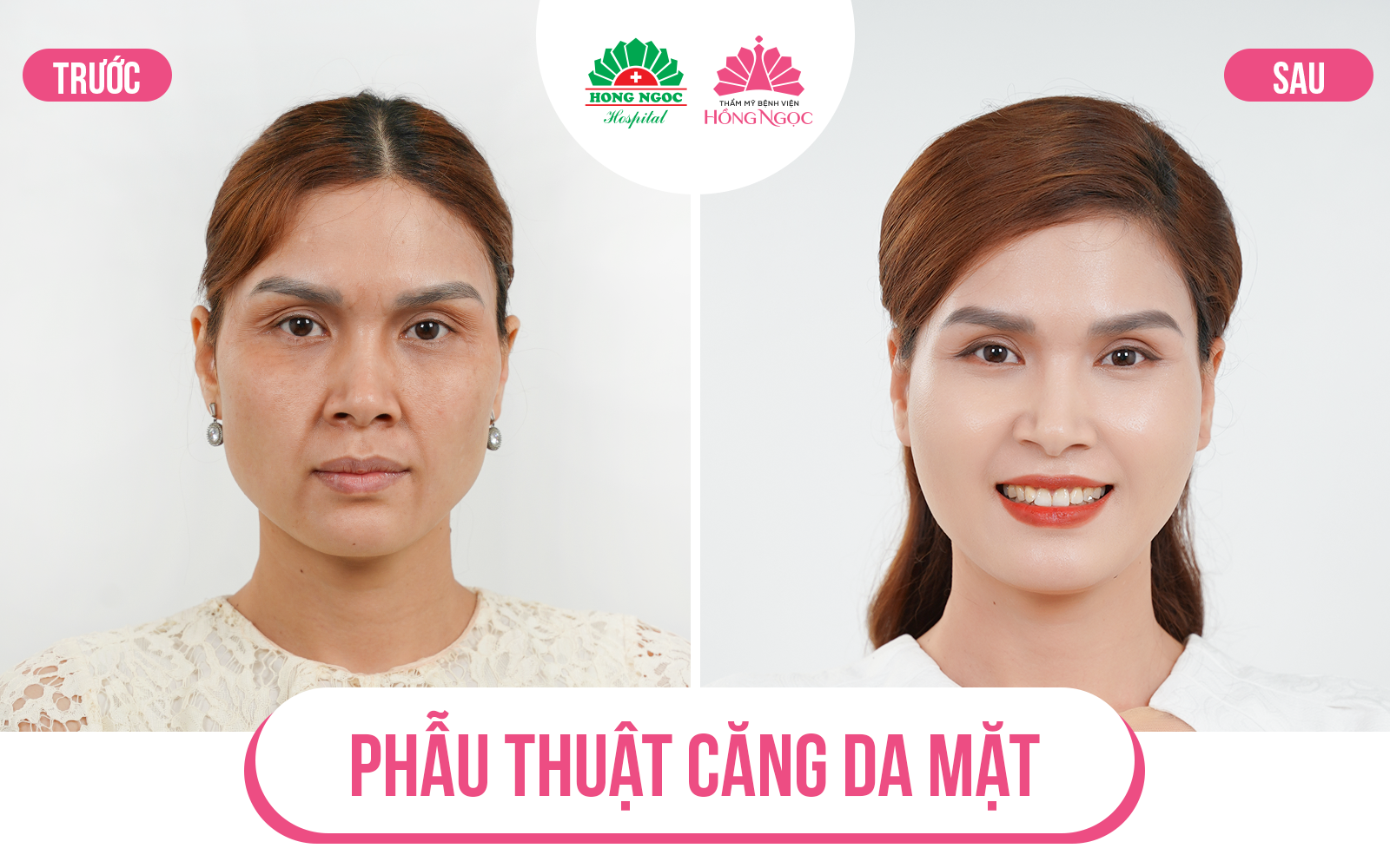 phẫu thuật căng da mặt toàn phần